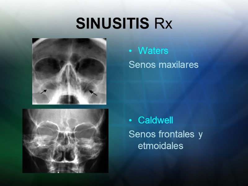 SINUSITIS Rx Waters Senos maxilares    Caldwell Senos frontales y etmoidales